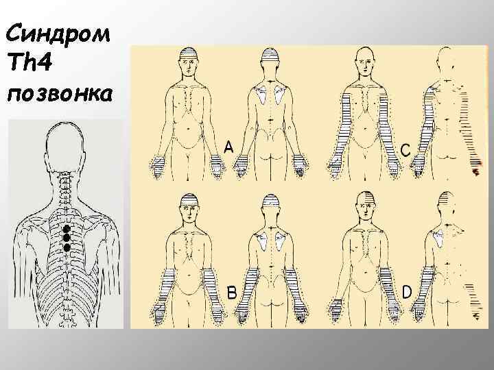 Синдром Th 4 позвонка 