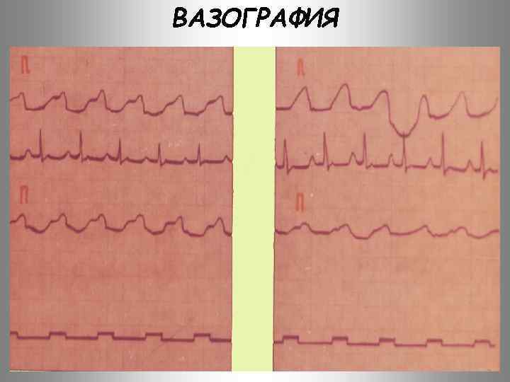 ВАЗОГРАФИЯ 