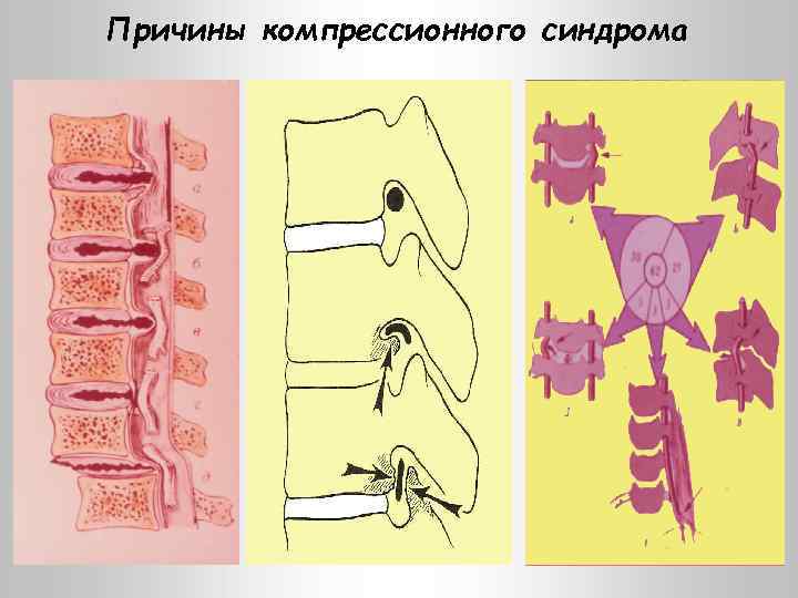 Причины компрессионного синдрома 