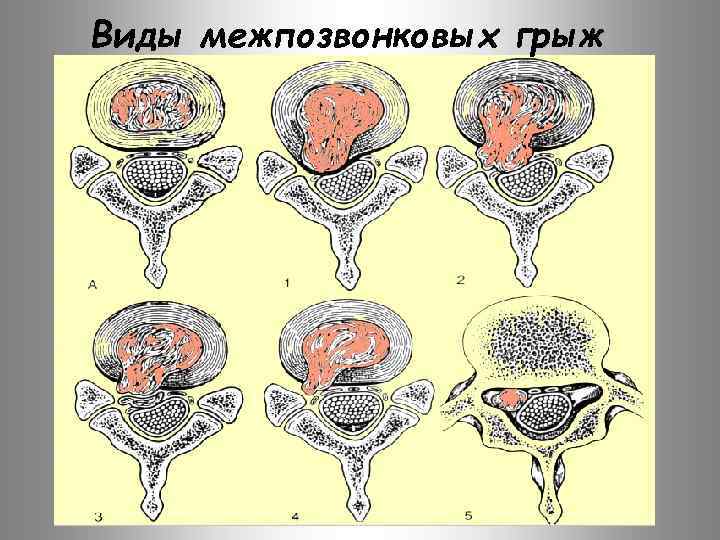 Виды межпозвонковых грыж 