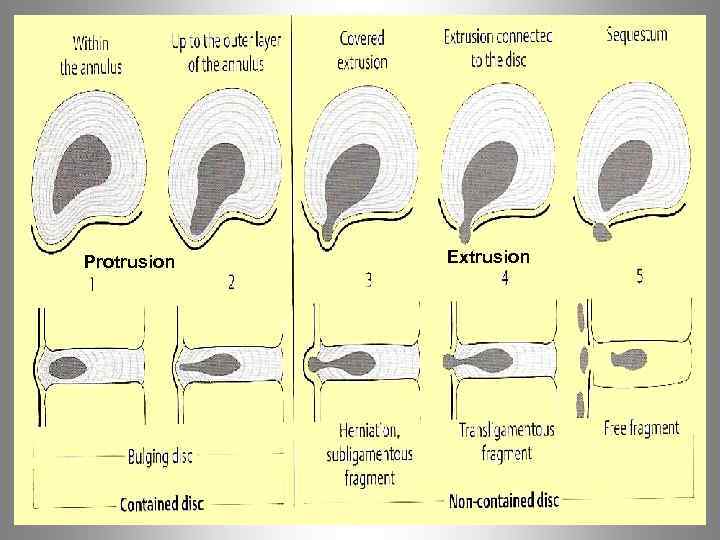 Protrusion Extrusion 