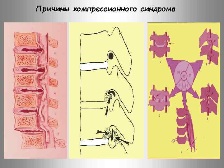 Причины компрессионного синдрома 