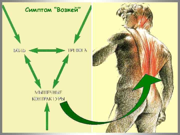 Симптом “Возжей” 