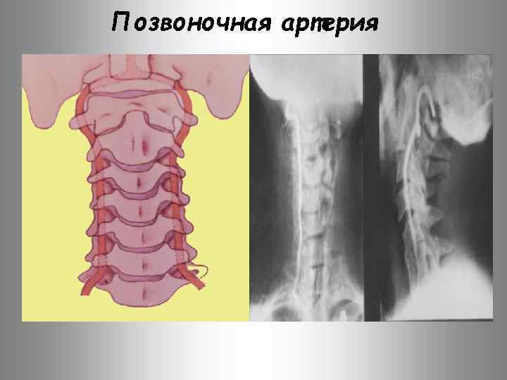 Позвоночная артерия 