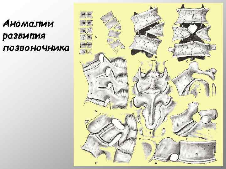 Аномалии развития позвоночника 