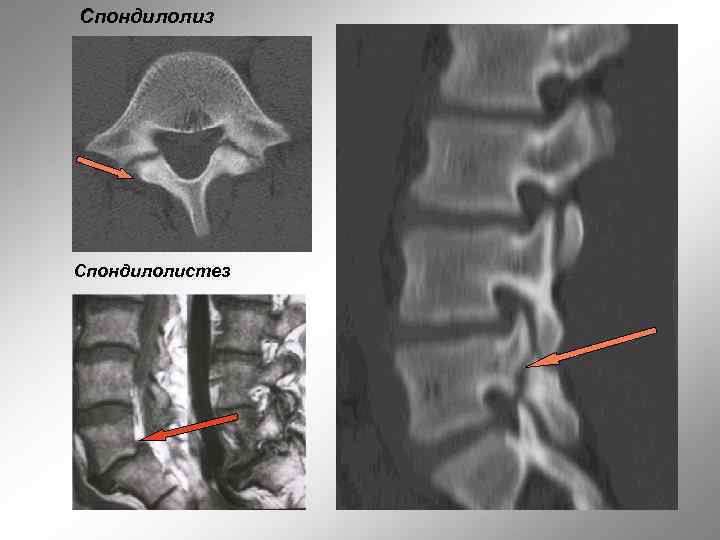 Спондилолиз Спондилолистез 