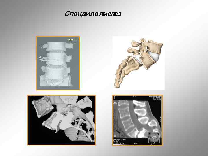 Спондилолистез 