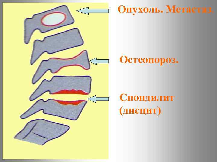 Опухоль. Метастаз. Остеопороз. Спондилит (дисцит) 