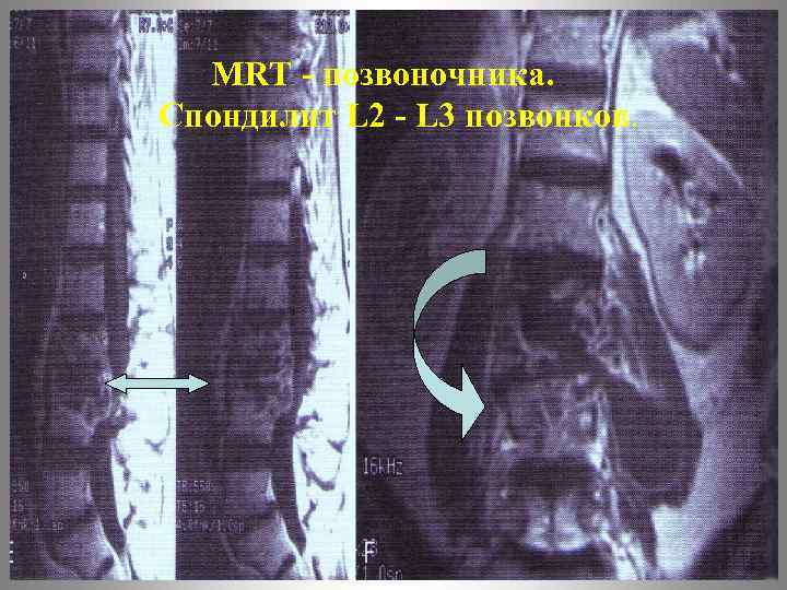 MRT - позвоночника. Спондилит L 2 - L 3 позвонков. 