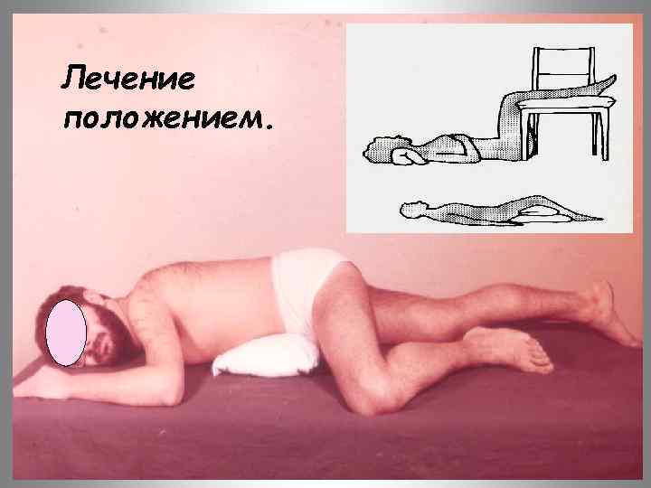 Лечение положением. 