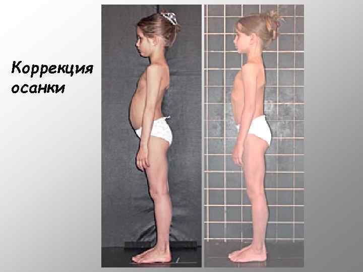Коррекция осанки 