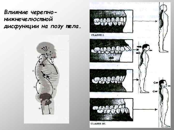 Влияние черепнонижнечелюстной дисфункции на позу тела. 