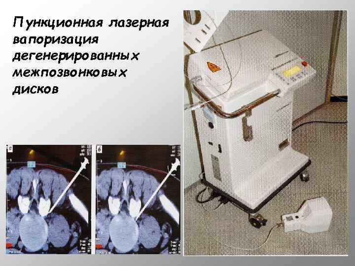 Пункционная лазерная вапоризация дегенерированных межпозвонковых дисков 
