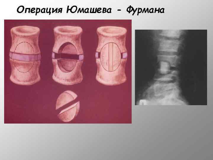 Операция Юмашева - Фурмана 