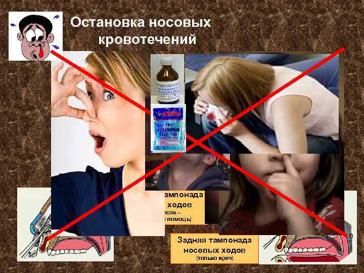 Остановка носовых кровотечений Передняя тампонада носовых ходов (в том числе – доврачебная помощь) Задняя
