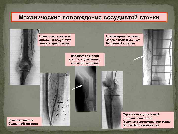 Механические повреждения сосудистой стенки Сдавление плечевой артерии в результате вывиха предплечья. Диафизарный перелом бедра