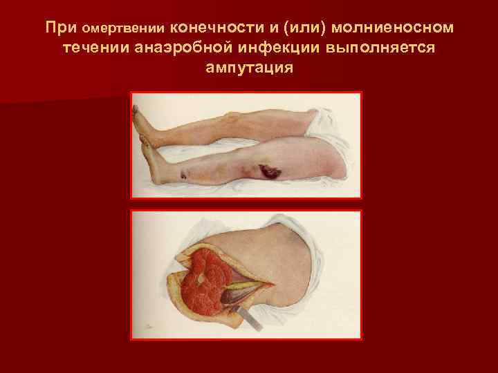 При омертвении конечности и (или) молниеносном течении анаэробной инфекции выполняется ампутация 