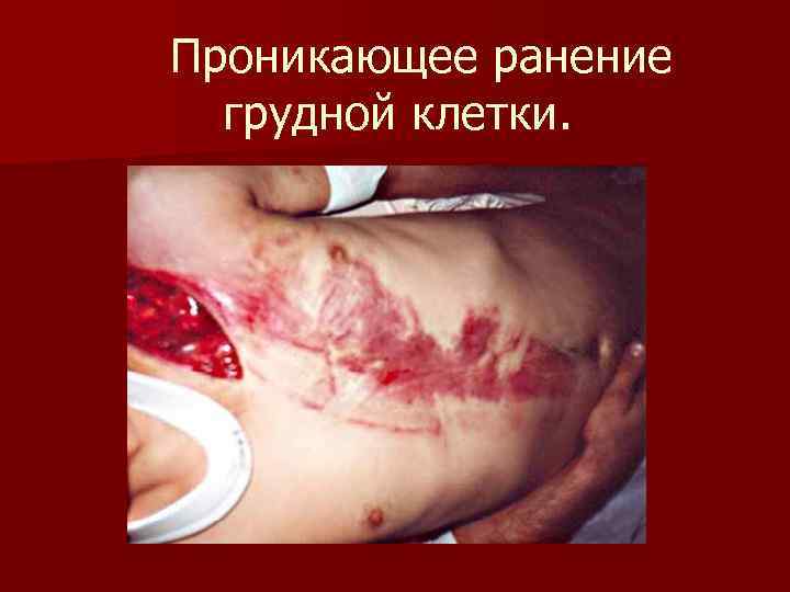 Проникающее ранение грудной клетки. 