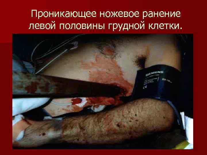 Проникающее ножевое ранение левой половины грудной клетки. 