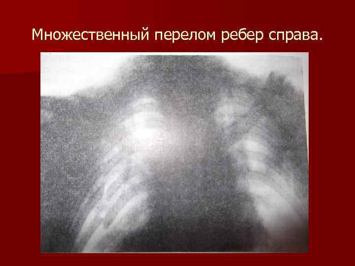 Множественный перелом ребер справа. 