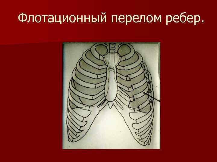 Флотационный перелом ребер. 