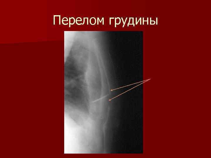 Перелом грудины карта вызова - 81 фото