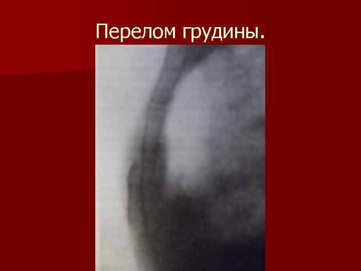 Перелом грудины. 