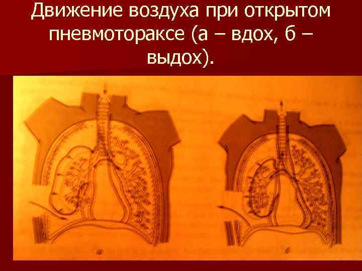 Движение воздуха при открытом пневмотораксе (а – вдох, б – выдох). 