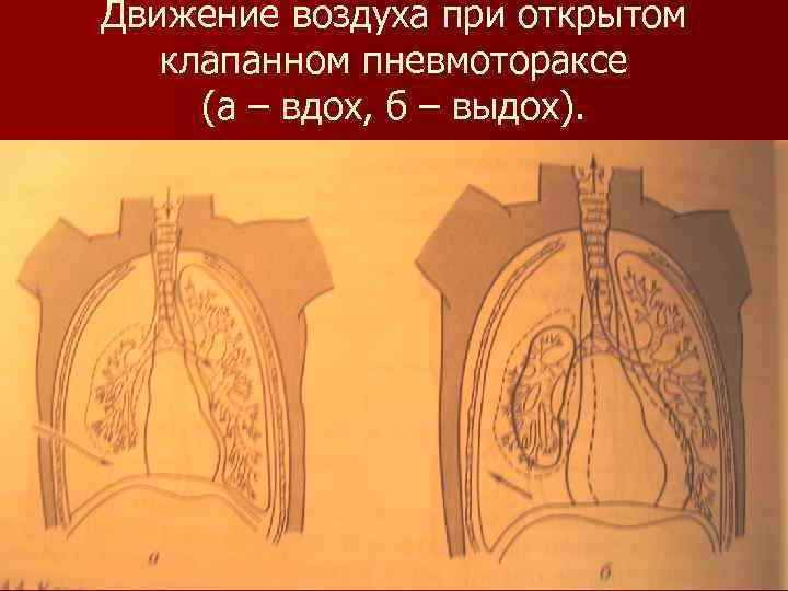 Движение воздуха при открытом клапанном пневмотораксе (а – вдох, б – выдох). 