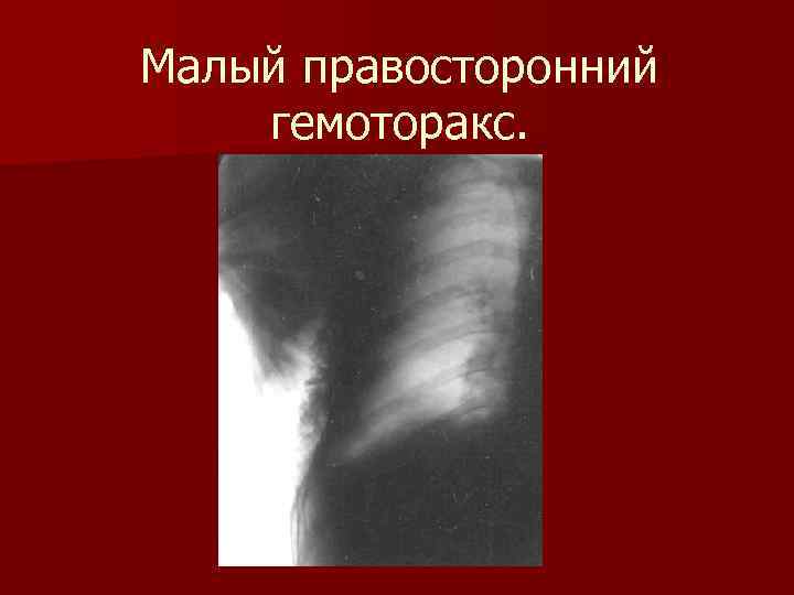 Малый правосторонний гемоторакс. 
