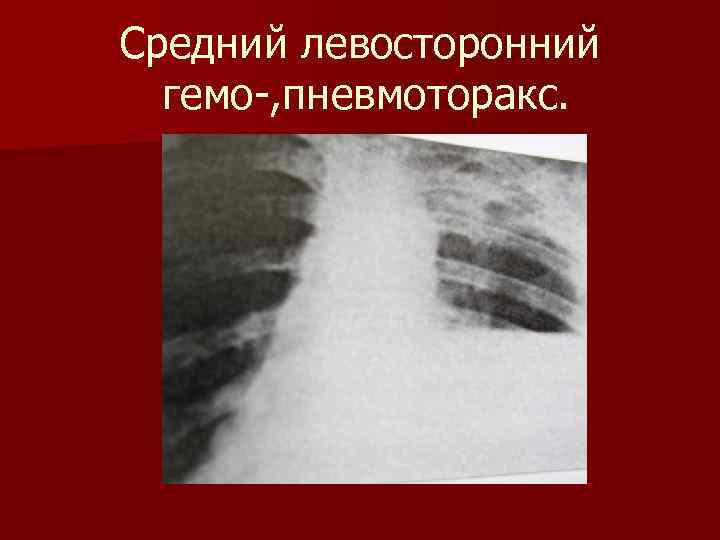 Средний левосторонний гемо-, пневмоторакс. 
