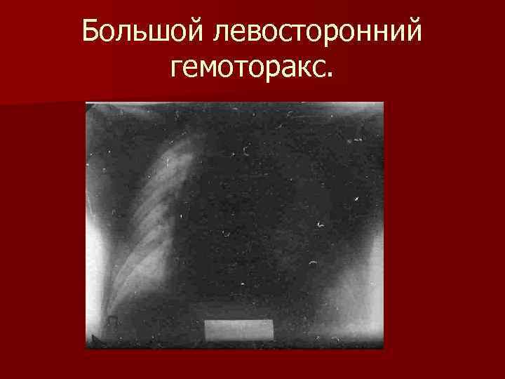 Большой левосторонний гемоторакс. 