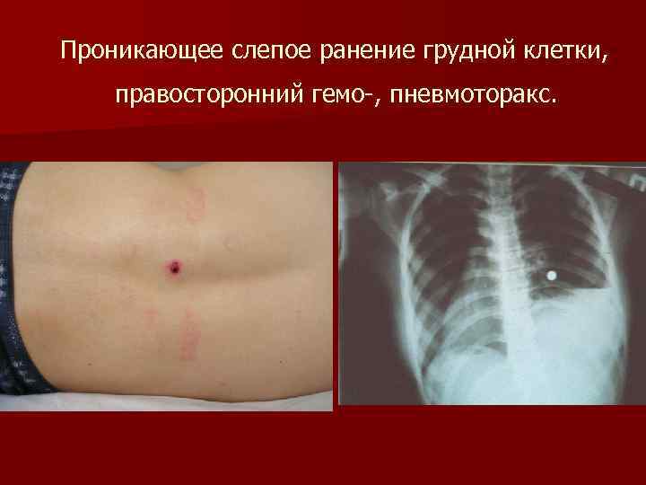 Проникающее слепое ранение грудной клетки, правосторонний гемо-, пневмоторакс. 