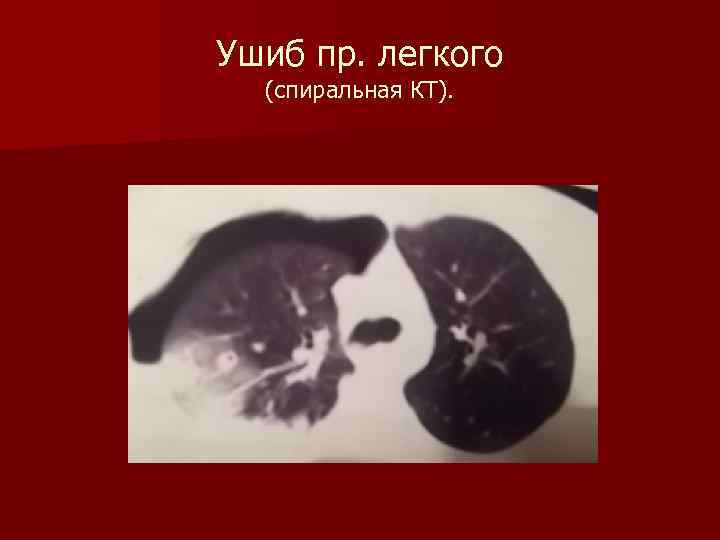 Ушиб пр. легкого (спиральная КТ). 