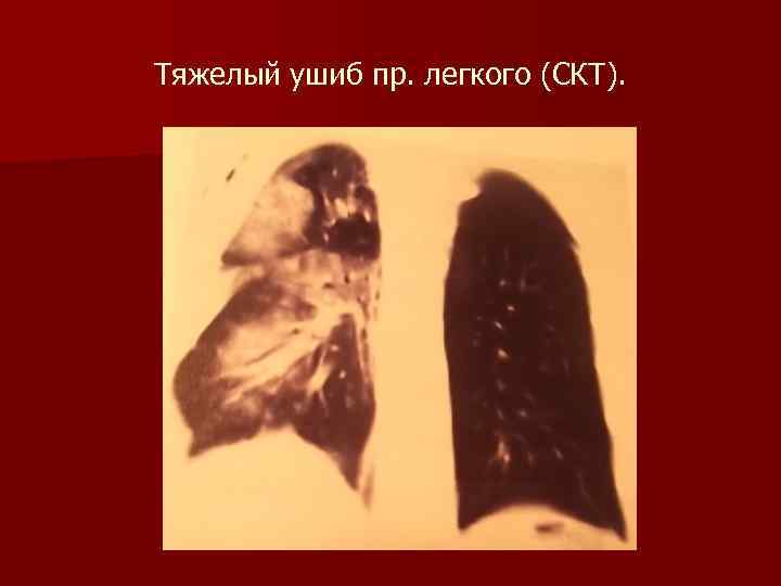 Тяжелый ушиб пр. легкого (СКТ). 