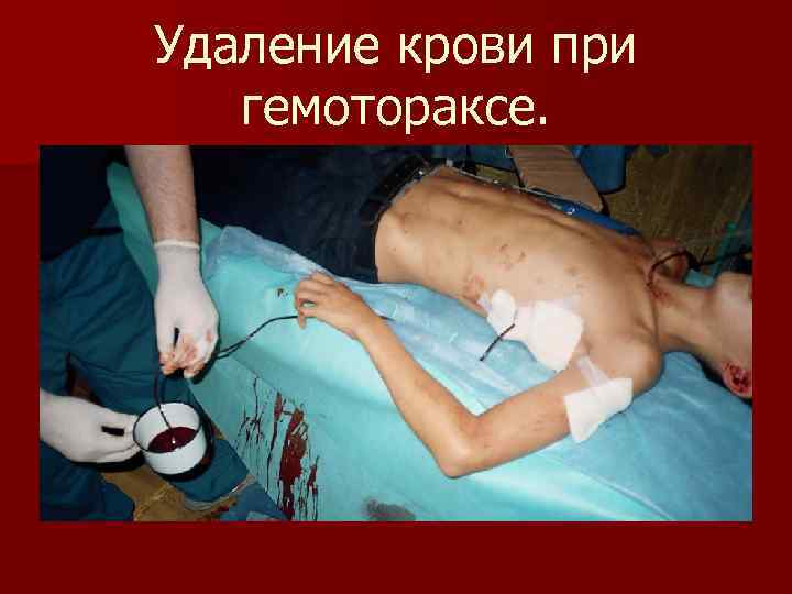 Удаление крови при гемотораксе. 