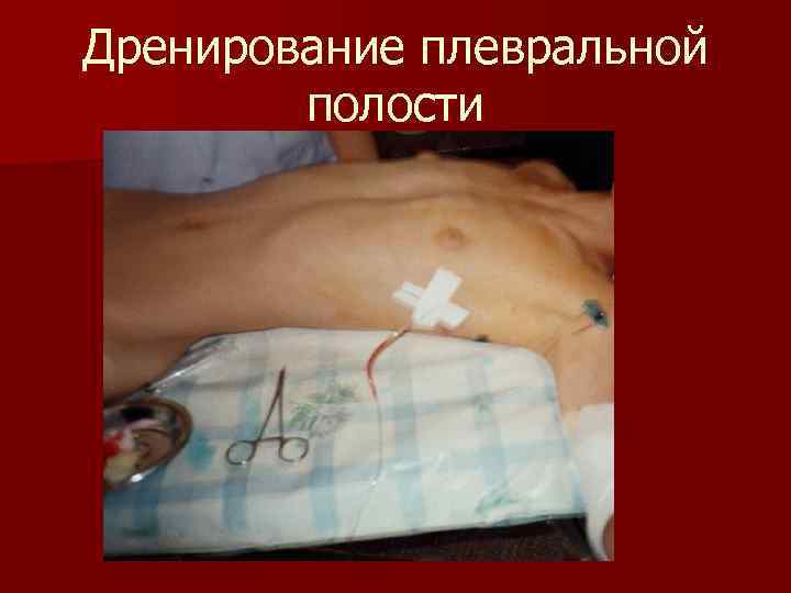 Дренирование плевральной полости 