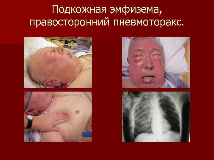 Подкожная эмфизема, правосторонний пневмоторакс. 