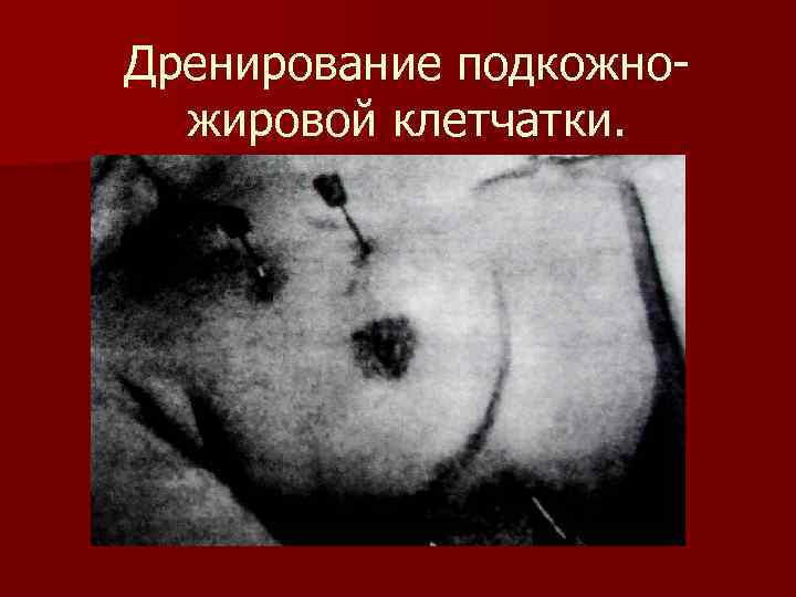 Дренирование подкожножировой клетчатки. 