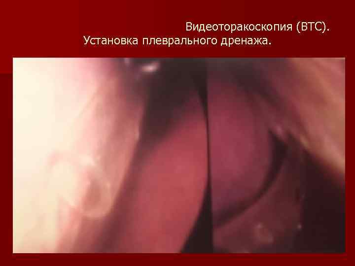 Видеоторакоскопия (ВТС). Установка плеврального дренажа. 