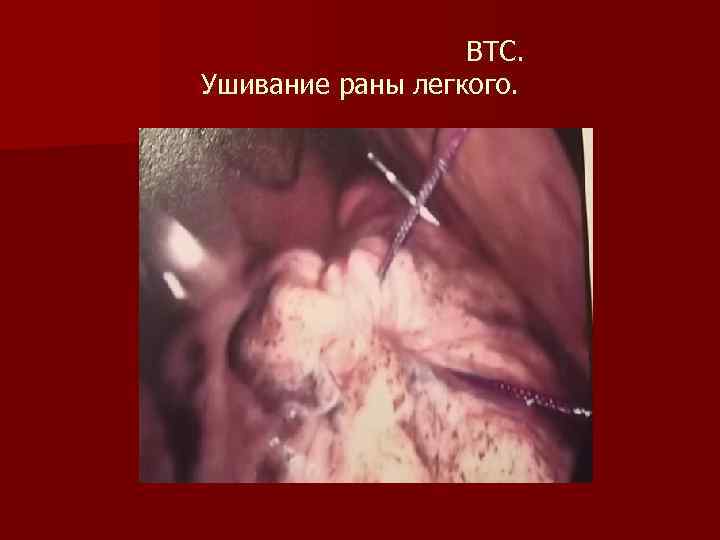 ВТС. Ушивание раны легкого. 