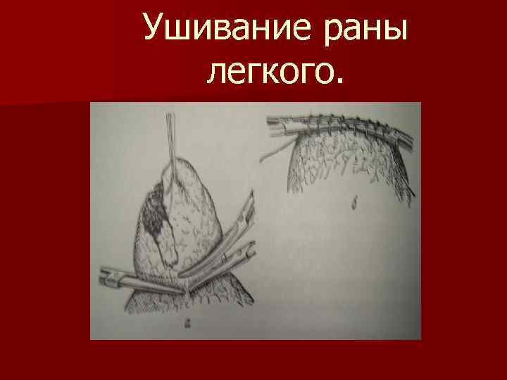 Ушивание раны легкого. 
