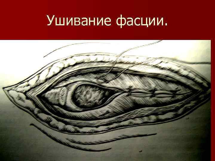Ушивание фасции. 