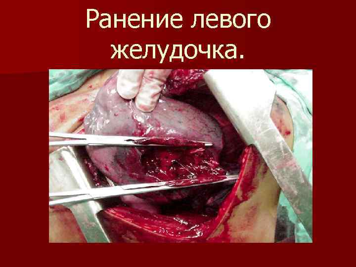 Ранение левого желудочка. 