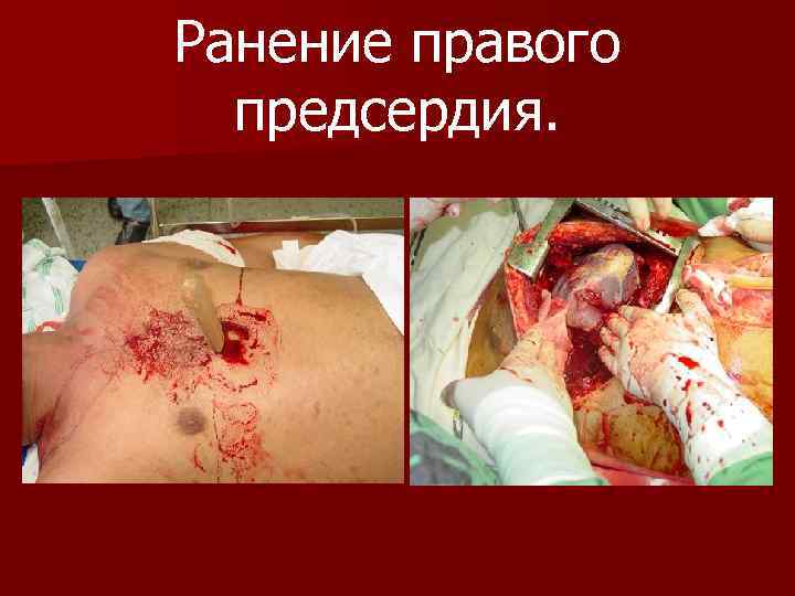 Ранение правого предсердия. 