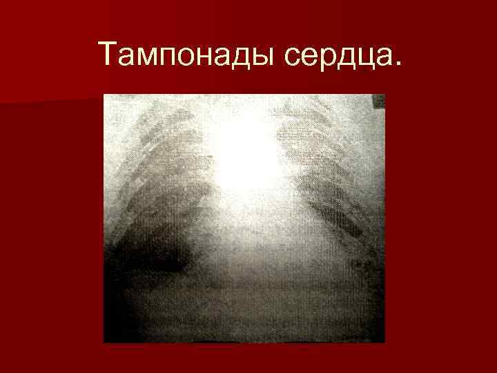 Тампонады сердца. 