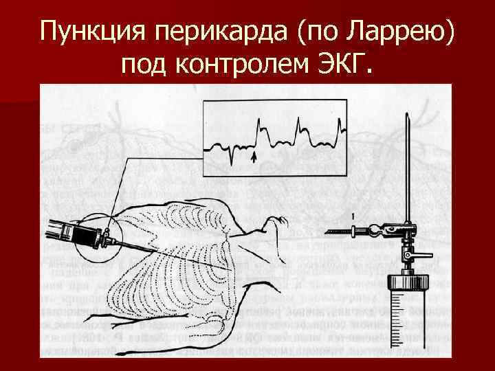 Пункция перикарда (по Ларрею) под контролем ЭКГ. 