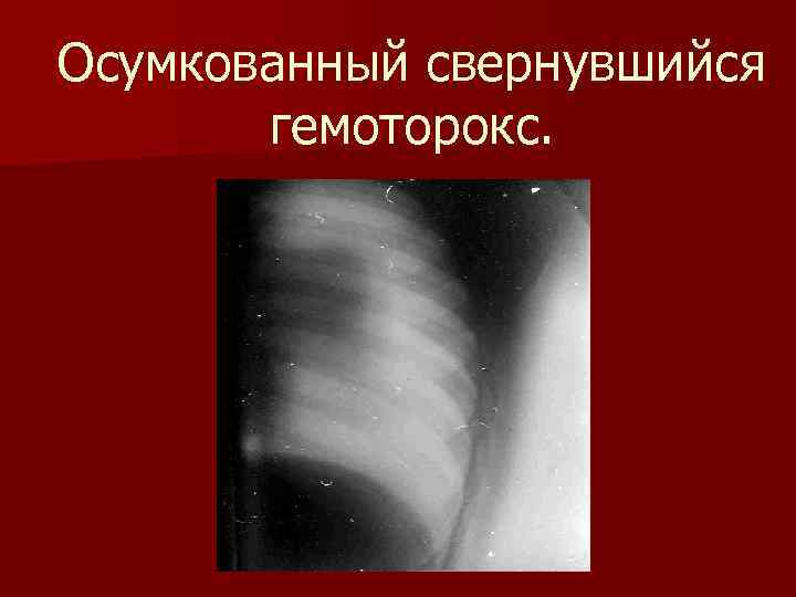 Осумкованный свернувшийся гемоторокс. 
