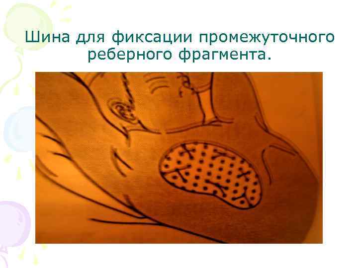 Шина для фиксации промежуточного реберного фрагмента. 