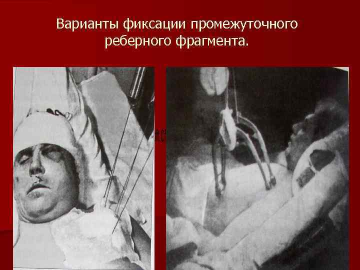 Варианты фиксации промежуточного реберного фрагмента. 